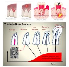 Image result for Periapical Abscess