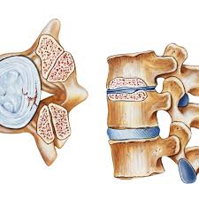 Boyunda olanına cervikal,sırtta olanına thoracal,belde olanına lumbal,kalça ve kuruk sokumunda olana ise sacral vertebra denir. Lateral Recess What Is It And Why Should You Care
