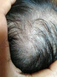 Choose a brush designed for toddler. My 4 Month Old Baby S Scalp Is Cracky With Some Dandruff Like Things Its Itchin