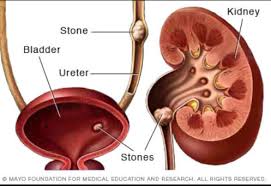 Kidney Stones Causes Symptoms And Available Treatments