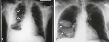 Pleural effusion is a lung condition characterized by fluid buildup outside the lungs. Thoracentesis Clinical Gate