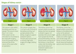 Stage ii and iii mean the cancer is larger and has grown into nearby tissues or lymph nodes. What Are The Different Kidney Cancer Stages Ikcc International Kidney Cancer Coalition