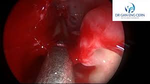 The treatment goal for nasal polyps is to reduce their size or eliminate them. Headaches In The Forehead Region After Sinus Surgery What Could Be The Cause Warning Graphic Surgical Images Videos Dr Gan Eng Cern
