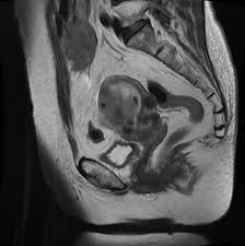 Image result for Neutropenic Colitis