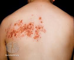 Image result for Varicella zoster on human skin