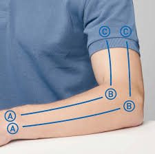Schmerzen / schmerz am (im) ellenbogengelenk, chondromatose. Ellenbogen Anwendungen Selbstanwender Anwendung Novafon