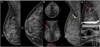 Image result for Mammogram Interpretation