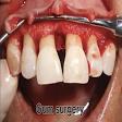 Gum surgeries at Gillore dental best dentist product image