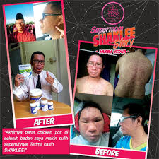 Sebelum kita mengetahui berapa lama kista sembuh dengan daun sirsak, alangkah baiknya apabila kita mengetahui mengenai penyakit kista dan manfaat yang diberikan oleh daun sirsak ini. Parut Chicken Pox Demam Campak Hilang Dengan Shaklee Pengedar Shaklee Shah Alam