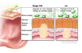Send thanks to the doctor. Colon Cancer Treatment Pdq Patient Version National Cancer Institute