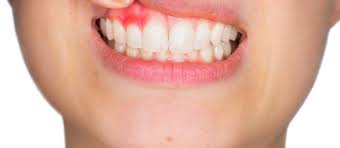 Home Remedies For Tooth & Gum Abscess – Volume 1 - Gilbert Dentist |  Premier Family Dental