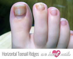 horizontal ridges on toenails