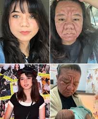 I'm Gillian and I had a beautiful childhood growing up in Botswana in  Africa. However, my face started to waste away during my teenage years, for  a reason I didn't know. At