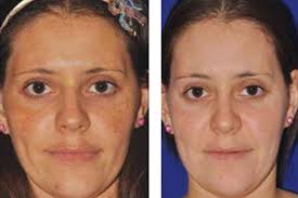 Fine lines & more · fragrance free · trusted reviews Micro Needling Nature S Gifts And Organic Spa