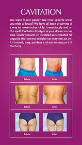 Cavitation Glow Clinics Radio Frequency Skin Tightening Laser Lipo Body Contouring