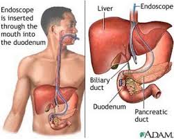 The gallbladder can develop a single large gallstone, hundreds of tiny stones, or both large and small stones. Endoscopic Bile Duct Stone Removal Abroad Affordable Gall Stone Removal Surgery In Costa Rica Mexico India Jordan Thailand