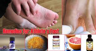 17 Home Remedies For Athlete S Foot Athletes Foot Remedies Home Remedies