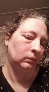 Does anyone experience swollen and throbbing limbs?