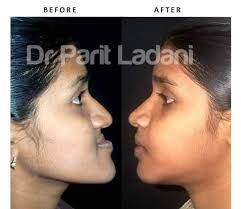 Kijabe surgeons Dr. Nthumba, Dr. Nolen, and Dr. Macharia work with a team  from Vanderbilt to perform free flap surgery, an amazing procedure in which  the fibula, a bone in the leg,