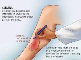 Most cellulitis infections can be treated with antibiotics that are taken by mouth (oral antibiotics). Cellulitis Causes Symptoms Diagnosis And Treatment In Madurai