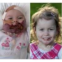 Tanda Lahir yang Hampir Mencekik Bayi