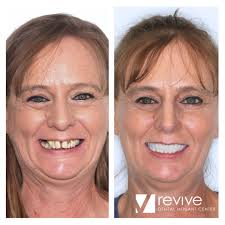 Revive Dental Implant Center (@revivedentalimplantcenter) • Instagram  photos and videos