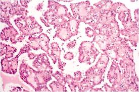 The purpose of this study is to report the. Selected Miscellaneous Ovarian Lesions Small Cell Carcinomas Mesothelial Lesions Mesenchymal And Mixed Neoplasms And Non Neoplastic Lesions Modern Pathology