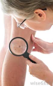 But hearing the words can still be scary. What Are Melanomas With Pictures