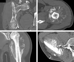 Image result for Osteosarcoma