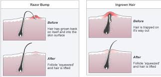 Tricks To Avoid Ingrown Hair After Shaving Treat Ingrown Hair Ingrown Hair Remedies Ingrown Hair