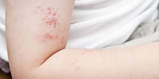 3 Cara Mengobati Herpes Dengan Bahan Alami Dan Langkah Pencegahannya Merdeka Com