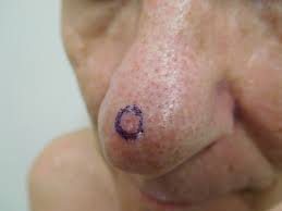 Basal cell carcinoma (bcc) is the most common type of skin cancer. Cureus Red Dot Basal Cell Carcinoma Report Of Cases And Review Of This Unique Presentation Of Basal Cell Carcinoma