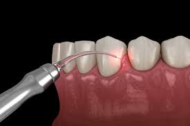 3 Types of Treatment for Gum Disease - All Smiles Dental Center San Antonio  Texas