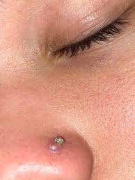 Formation of bumps and abscess is also a common sign of infected nose piercing. I Ve Had My Nose Pierced For About A Now Is It Infected Or Is This Just Part Of The Healing Process Nosepiercing