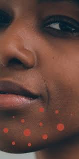 Antibiotics, which are taken for a short period of time and stopped when symptoms clear up birth control pills (for women) to help balance your hormone levels isotretinoin, which is typically used in severe cases that are unresponsive to other medications Cystic Acne Treatment What S Up With Those Large Painful Pimples That Won T Go Away Self