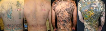 Tattoo removal expert, mary garnett, performs a picosure treatment on a solid black tattoo at clean slate laser center in white. Size Doesn T Matter With Picosure Laser Tattoo Removal Austinpicosure Com A Tattoo Removal Nurse S Notes