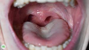 It was just something that doctors did a lot back then (i got lousy. My 30 Day Experience After A Tonsillectomy Surgery No Surgery Footage Youtube