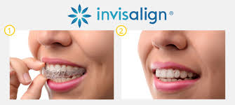 Find out why and what you can expect to pay. Chicago Invisalign Dentist In Lakeview Belmont Dental Care