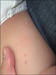 What are the different types of herpes? Discrete Papules On The Thigh Of A Child Photo Quiz American Family Physician