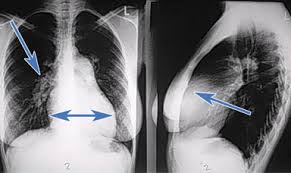 Diagnose Der Pulmonal Arteriellen Hypertonie Bildgebende Verfahren Diagnostik Der Pulmonal Arteriellen Hypertonie Pah Arztcme