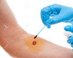 Nurse Applying Arm With Iodine Solution Stock Photo Picture And Royalty Free Image Image 41904764