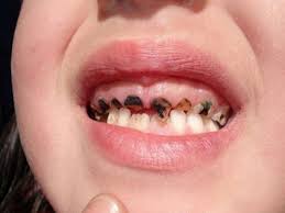 Trẻ bị răng sún, mẹ cần làm gì?