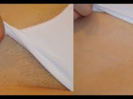 The following should be considered before deciding to use laser hair removal for a brazilian. Brazilian Laser Hair Removal Pulse Light Clinic London