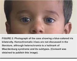 Figure 2 From A Case Of Waardenburg Shah Syndrome Type 4 Presenting With Bilateral Homochromatic Blue Irises From Pakistan Semantic Scholar