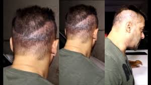 С 2013 года ип цацулин б.а. Pin On Satya Hair Transplantation