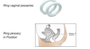 Image result for Pessary