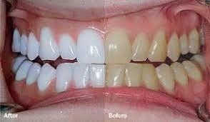 Worlds leading professional teeth whitening company and the only one that brings you whiter teeth for life for free #teethwhitening. Zoom Whitening Nyc Tribeca Ny Teeth Whitening