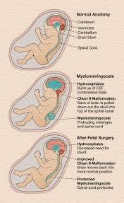 Image result for Hydrocephalus