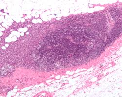 Stage 0 Breast Cancer When Should You Wait And See