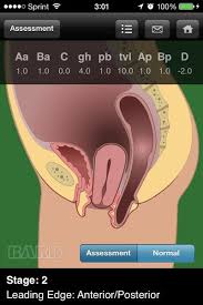 2013 10 20 03 01 14 Medical App Pelvic Organ Prolapse Assessment Tools